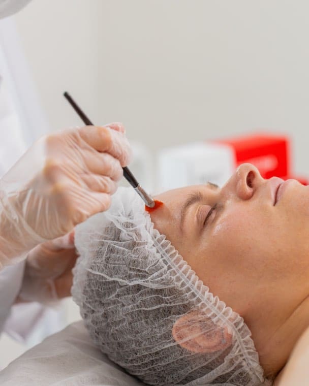 Kuracja rozjaśniająca Cosmelan, aplikacja peelingu medycznego, centrum CosmetDerm we Wrocławiu